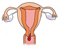 内 ポリープ 子宮 膜 子宮内膜ポリープ